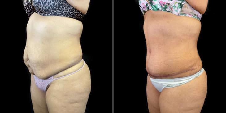 Before & After Stomach Tuck Surgery Atlanta ¾ View