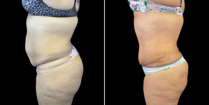 Before & After Stomach Tuck Surgery Atlanta Side View