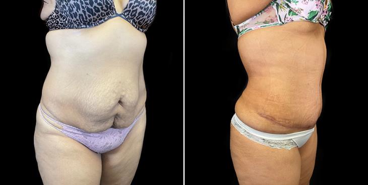 ¾ View Before & After Stomach Tuck Surgery Atlanta
