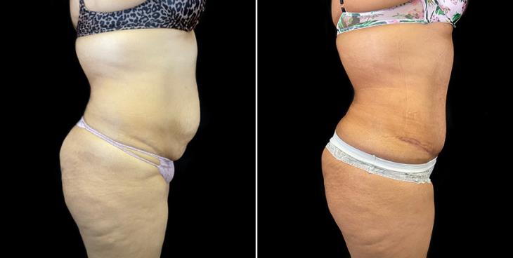 Side View Before & After Stomach Tuck Surgery Atlanta