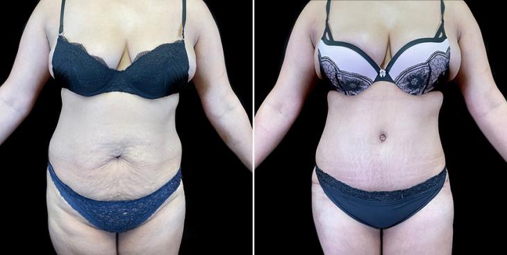 Before & After Tummy Tuck Atlanta