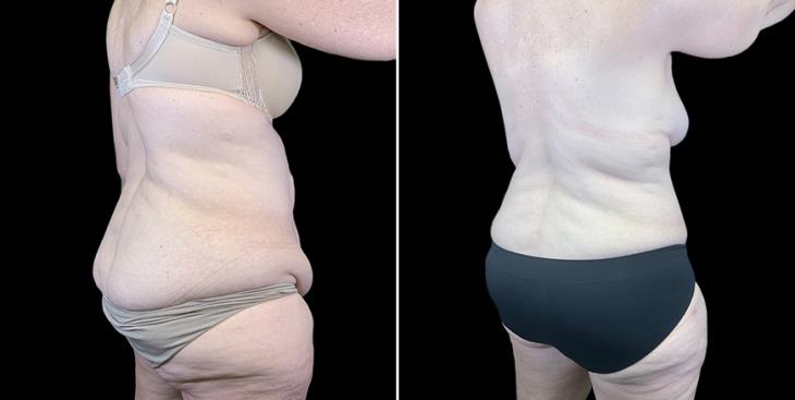 ¾ Back View Before & After Stomach Tuck Surgery Atlanta Georgia