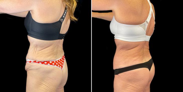 Before And After Stomach Tuck Surgery Atlanta GA ¾ Back View