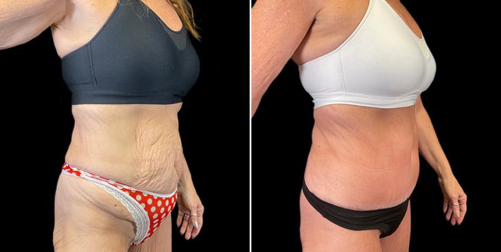 Before And After Stomach Tuck Surgery Atlanta GA ¾ View