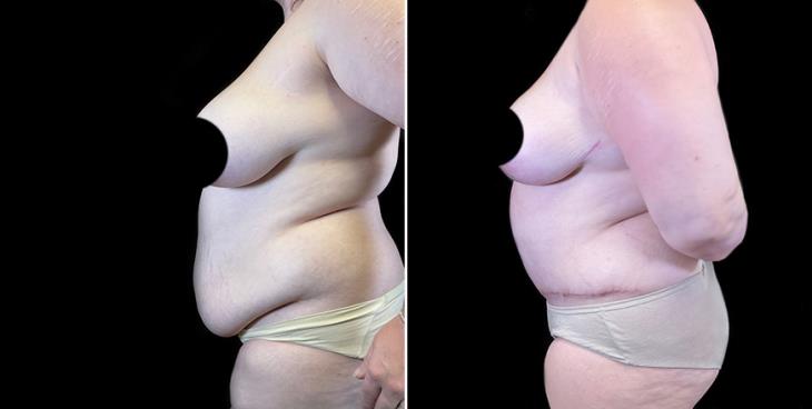 Before & After Liposuction Surgery Atlanta Side View