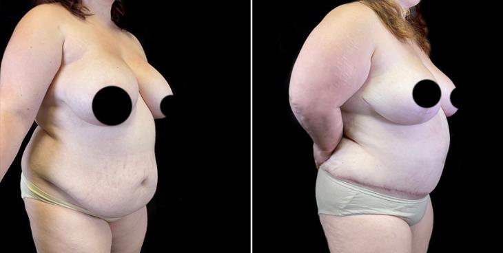 ¾ Side View Before & After Liposuction Surgery Atlanta