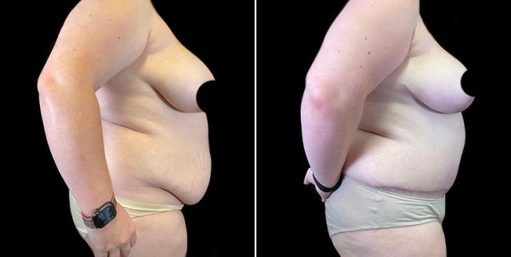 Side View Before & After Liposuction Surgery Atlanta