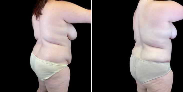 ¾ Back View Before & After Liposuction Surgery Atlanta
