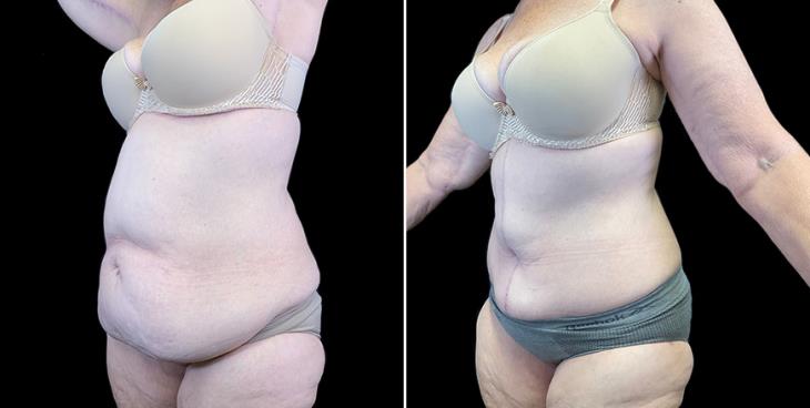 ¾ View Before & After Liposuction Surgery Atlanta GA