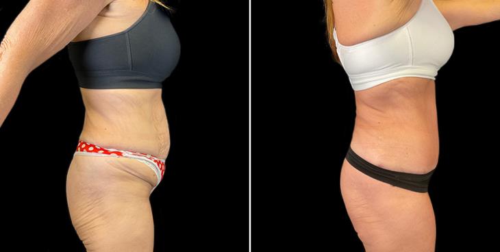 Side View Before & After Liposuction Surgery Atlanta Georgia