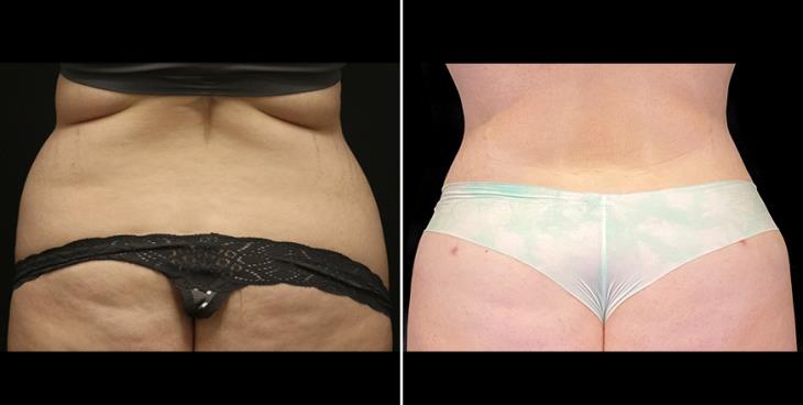 Before & After Tummy Tuck Surgery Atlanta Georgia Close-Up