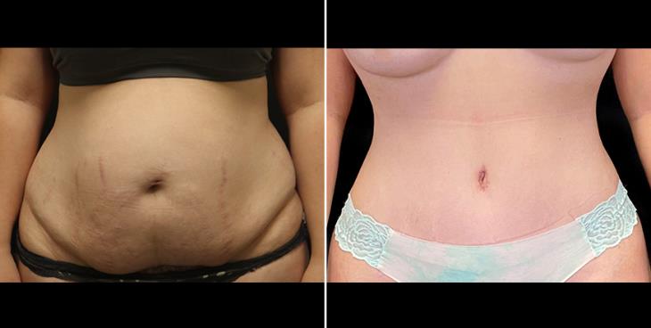 Close-Up Before & After Liposuction Surgery Atlanta Georgia