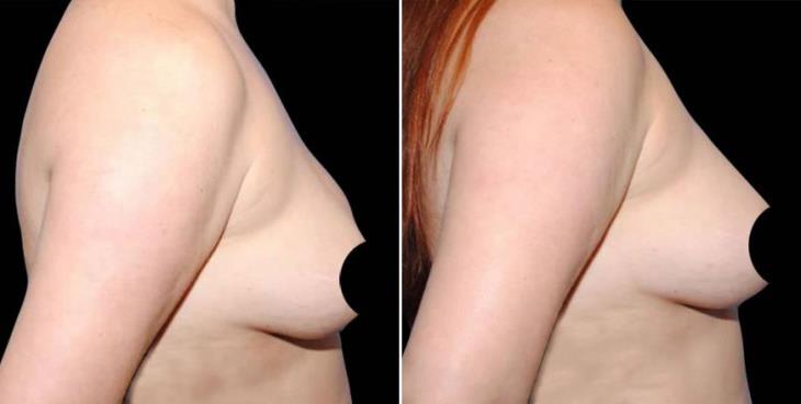Before And After Breast Augmentation Atlanta