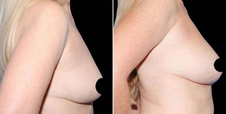 Atlanta Breast Augmentation Before And After