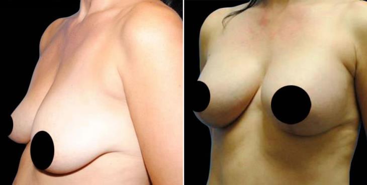 Atlanta Breast Augmentation Before & After Side View