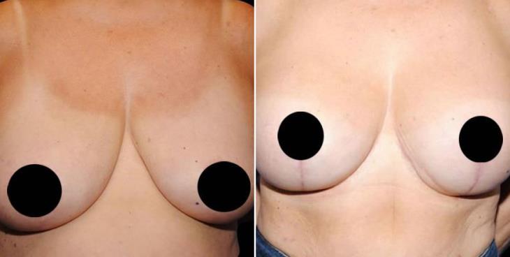 Georgia Breast Augmentation Before And After