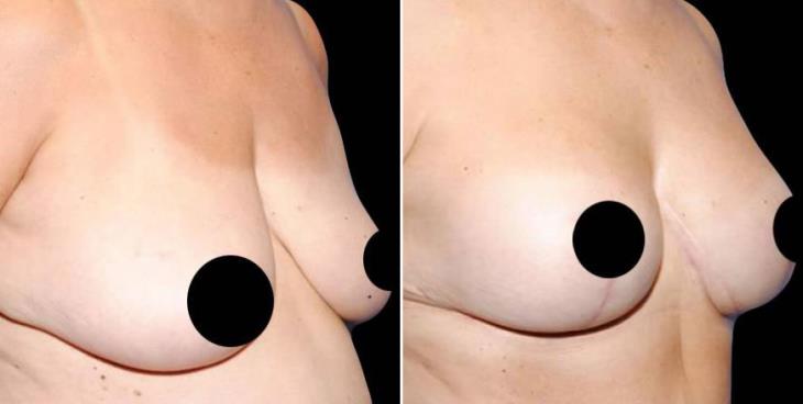 Georgia Breast Augmentation Before And After Side View