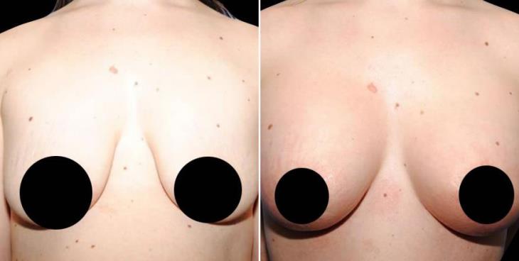 Georgia Breast Augmentation Before & After