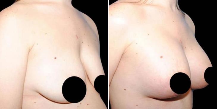 Georgia Breast Augmentation Before & After Side View