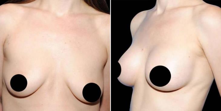 Before And After Breast Augmentation Atlanta Georgia