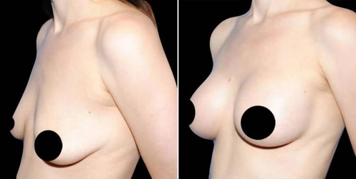 Before And After Breast Augmentation Atlanta Georgia Side View