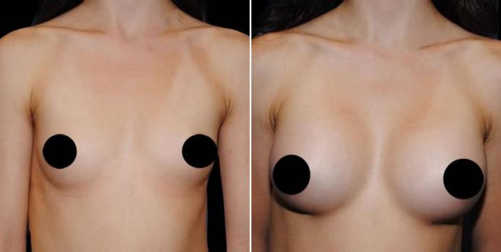 Atlanta Georgia Breast Augmentation Before And After