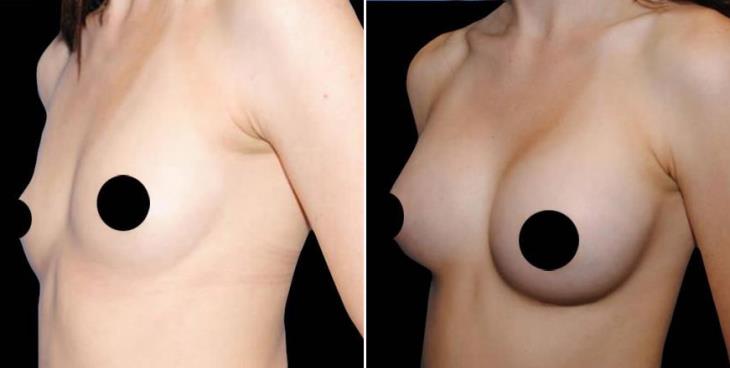 Atlanta Georgia Breast Augmentation Before And After Side View