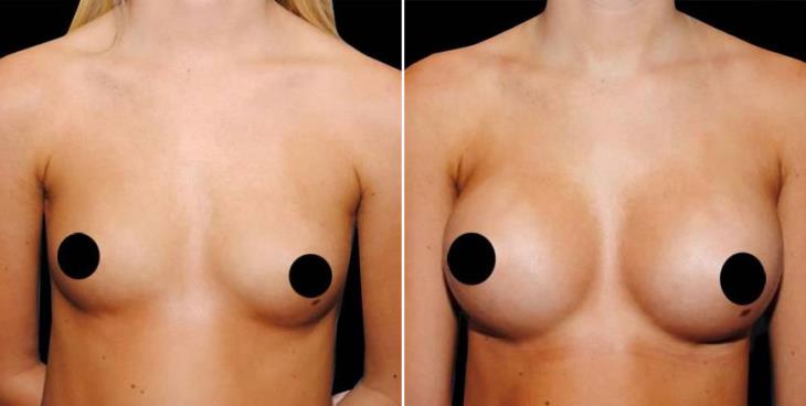 Before And After Breast Augmentation Atlanta GA