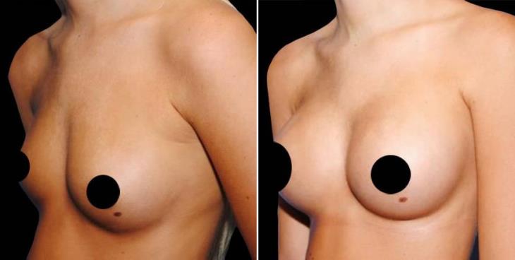 Before And After Breast Augmentation Atlanta GA Side View