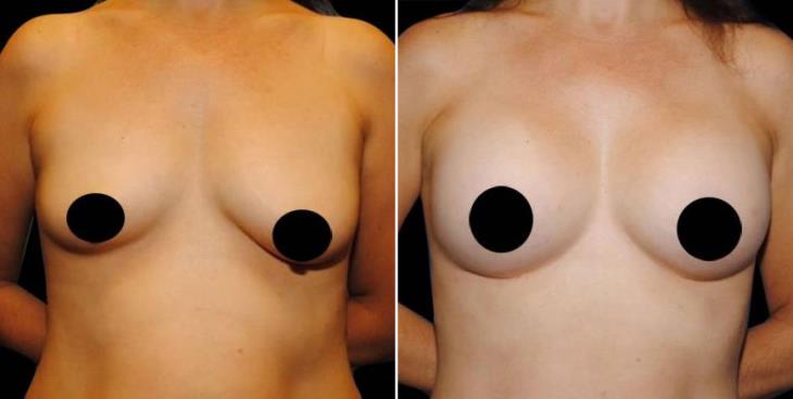 Atlanta GA Breast Augmentation Before And After