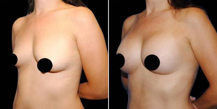 Atlanta GA Breast Augmentation Before And After Side View