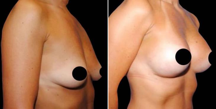 Breast Augmentation Results Atlanta Side View