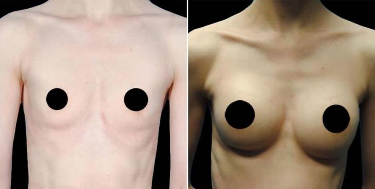 Before & After Breast Augmentation Atlanta GA