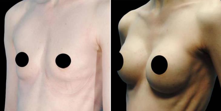 Before & After Breast Augmentation Atlanta GA Side View