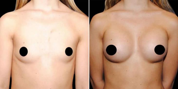 Atlanta GA Breast Augmentation Before & After