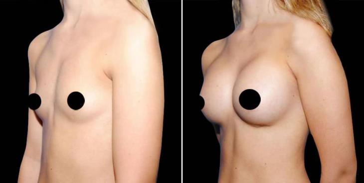 Atlanta GA Breast Augmentation Before & After Side View