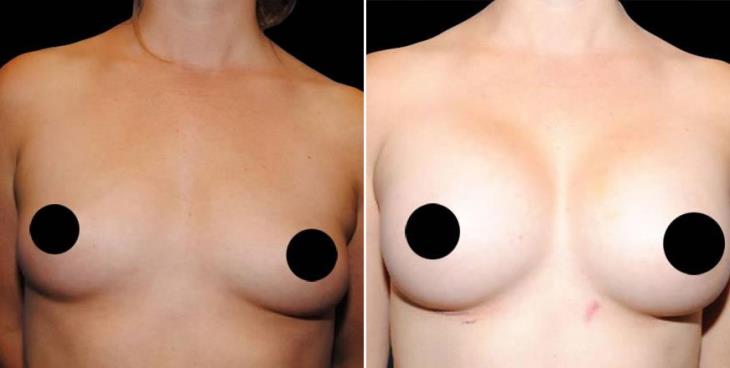 Breast Implant Results