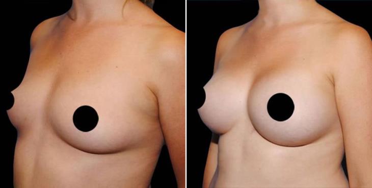 Breast Implant Results Side View