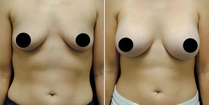 Breast Implant Results Atlanta