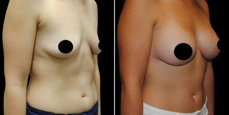 Before And After Breast Implants Atlanta