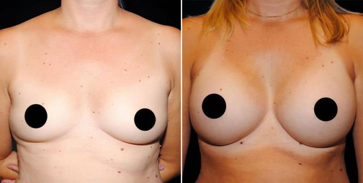 Atlanta Breast Implant Results