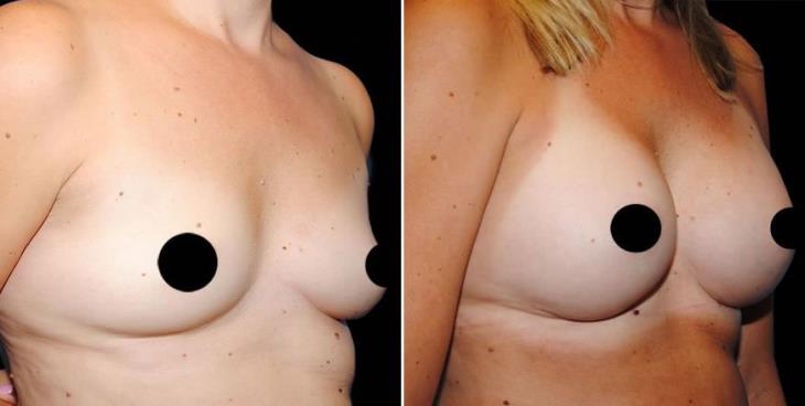 Atlanta Breast Implant Results Side View