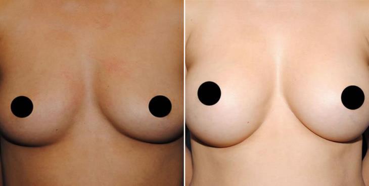 Breast Implant Results Atlanta GA