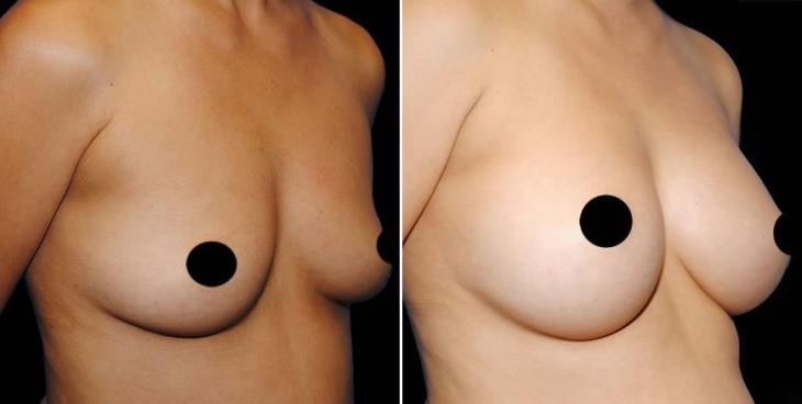 Breast Implant Results Atlanta GA Side View