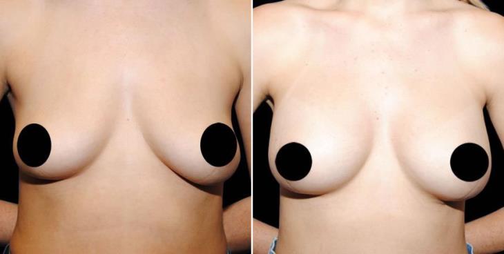 Atlanta GA Breast Implant Results