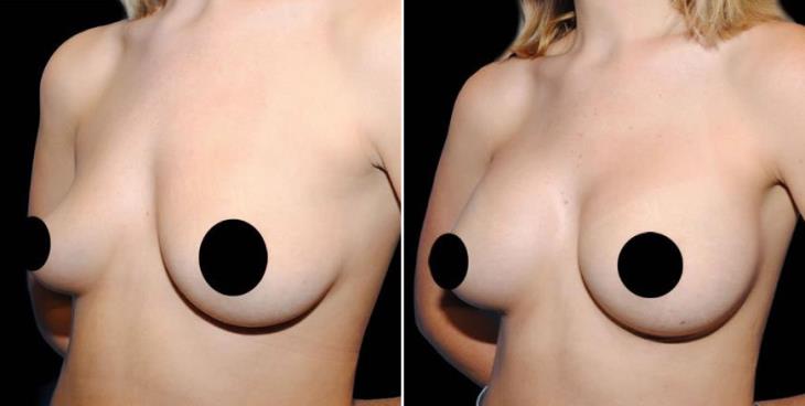 Atlanta GA Breast Implant Results Side View