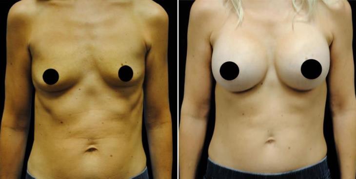 Breast Implant Results Atlanta Georgia