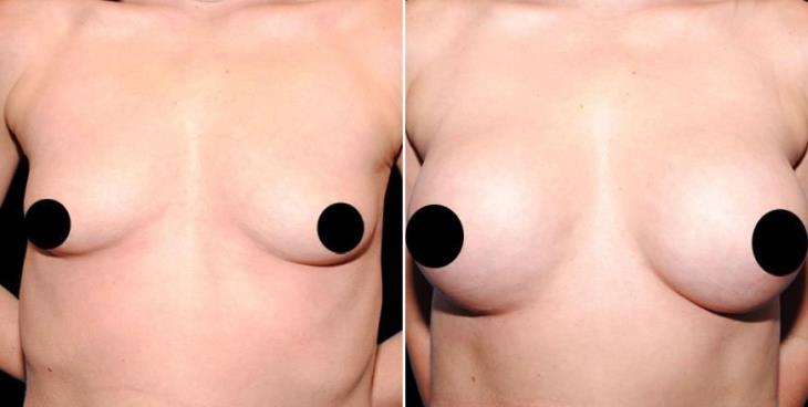 Atlanta Georgia Breast Implant Results 