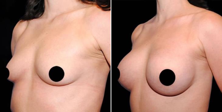 Atlanta Georgia Breast Implant Results Side View