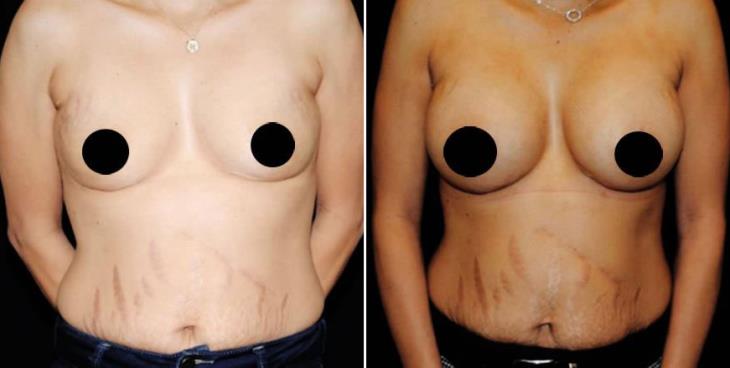 Before & After Breast Implants